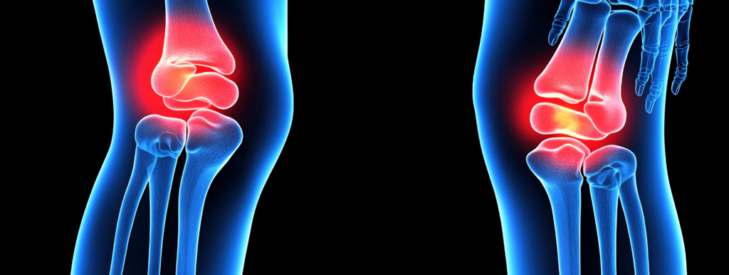 Serotonin and inflammation, inflammation, arthritis