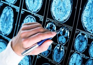 Alzheimer's brain scans, brain scans, Alzheimer's disease